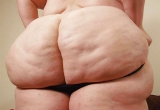 Cellulite 21