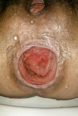 anal hole