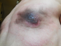 My tits in pain (nipples removed) - N