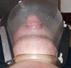 Pumping salined balls - N
